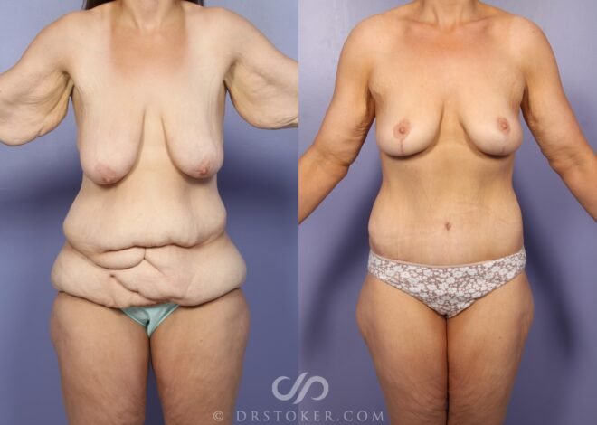 Breasts After Weight Loss: What to Expect and How to Enhance