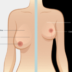 Breast Weight Loss: Effective Strategies Revealed