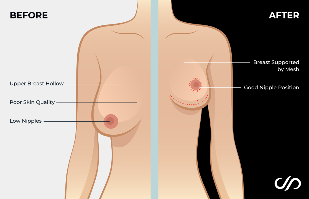 Breast Weight Loss: Effective Strategies Revealed