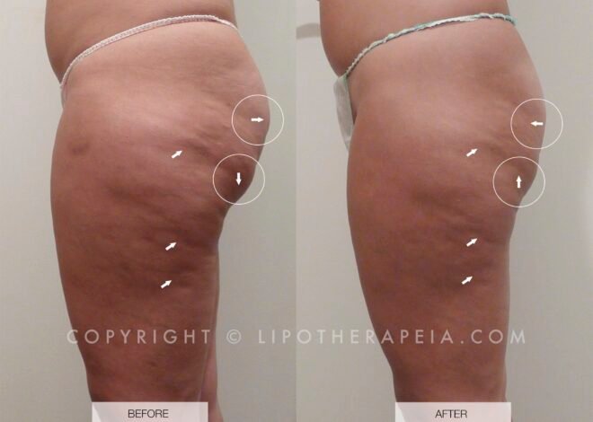 Cellulite Before And After Weight Loss Pics: Stunning Results