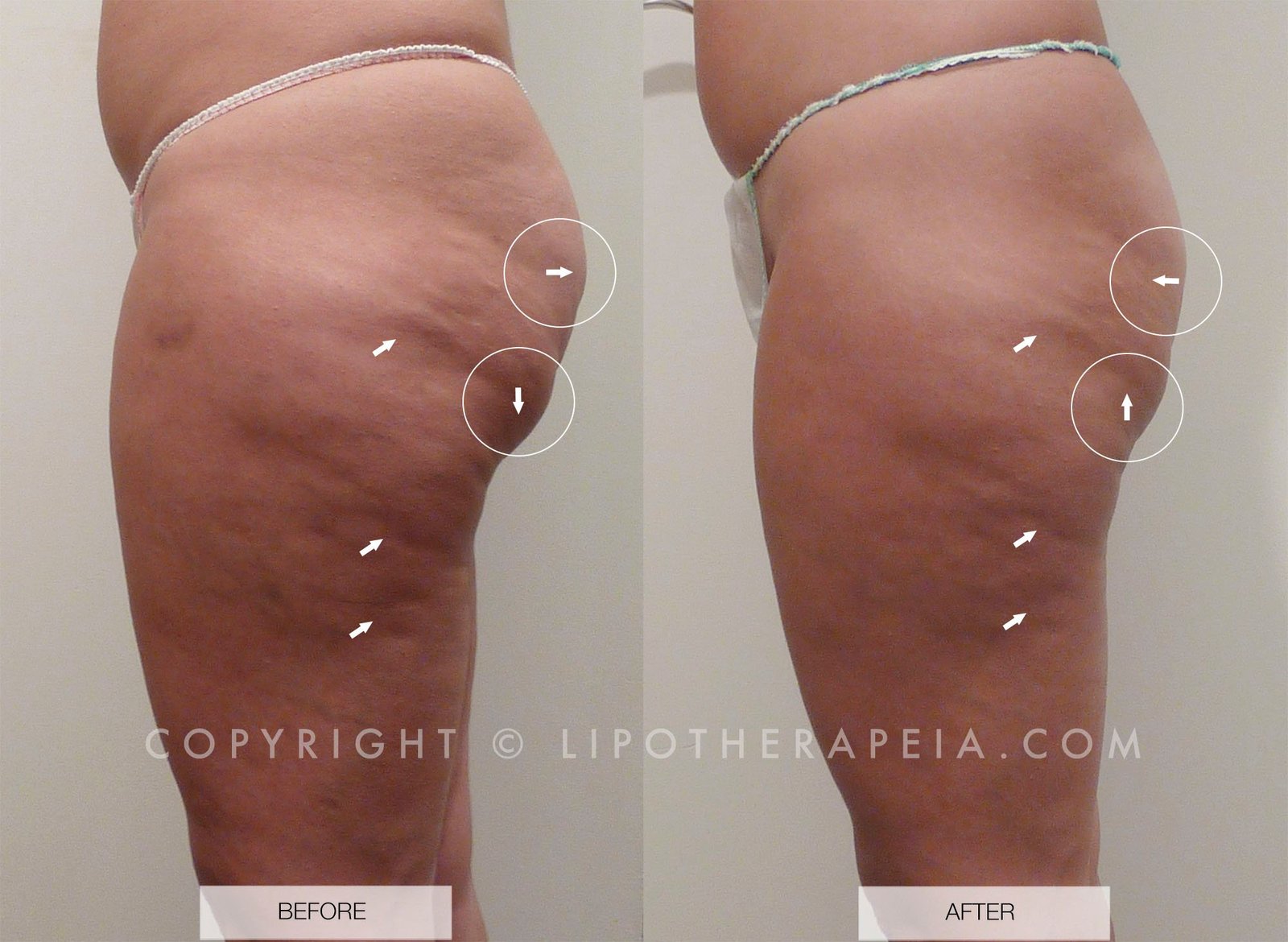Cellulite Before And After Weight Loss Pics: Stunning Results