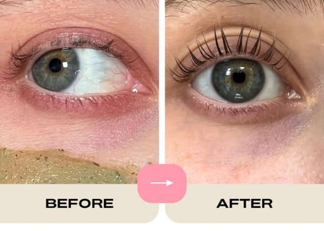 Orbital Fat Loss: Transform Your Eye Area Now